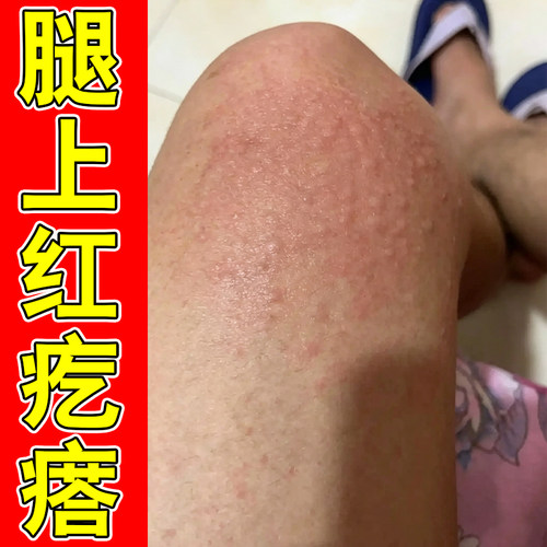 腿上红疙瘩痒皮肤过敏风团小腿痒起小红点疙瘩身上痒外用修复软膏