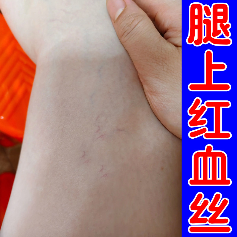 腿上红血丝外用修复毛细血管扩张血丝腿久站学生成人通用软膏