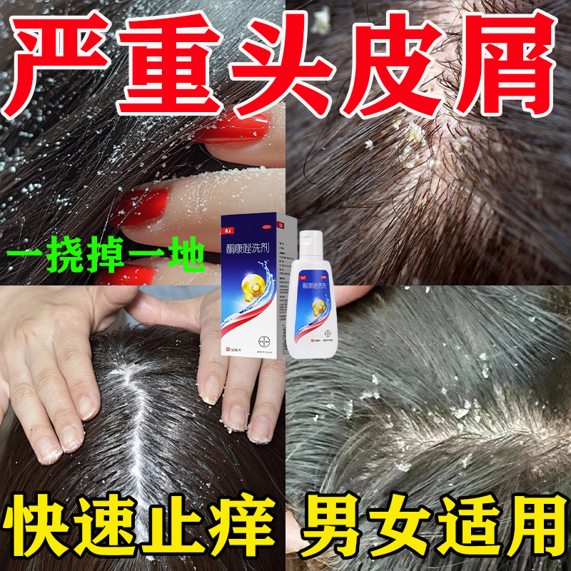 康王酮康唑洗剂头皮屑严重去头屑药脂溢性皮炎去屑止痒专用洗发水