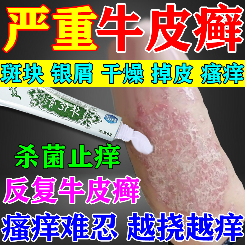 治牛皮癣药膏顽固牛皮癣银屑病专用软膏药抑菌止痒皮肤外用膏