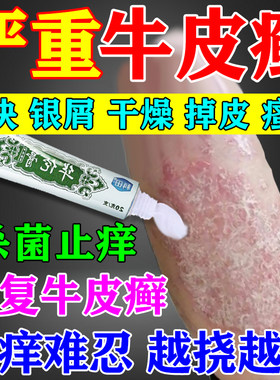 治牛皮癣药膏顽固牛皮癣银屑病专用软膏药抑菌止痒皮肤外用膏