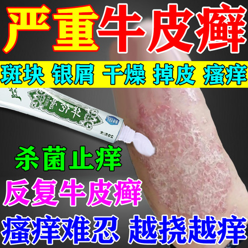 治牛皮癣药膏顽固牛皮癣银屑病专用软膏药抑菌止痒皮肤外用膏