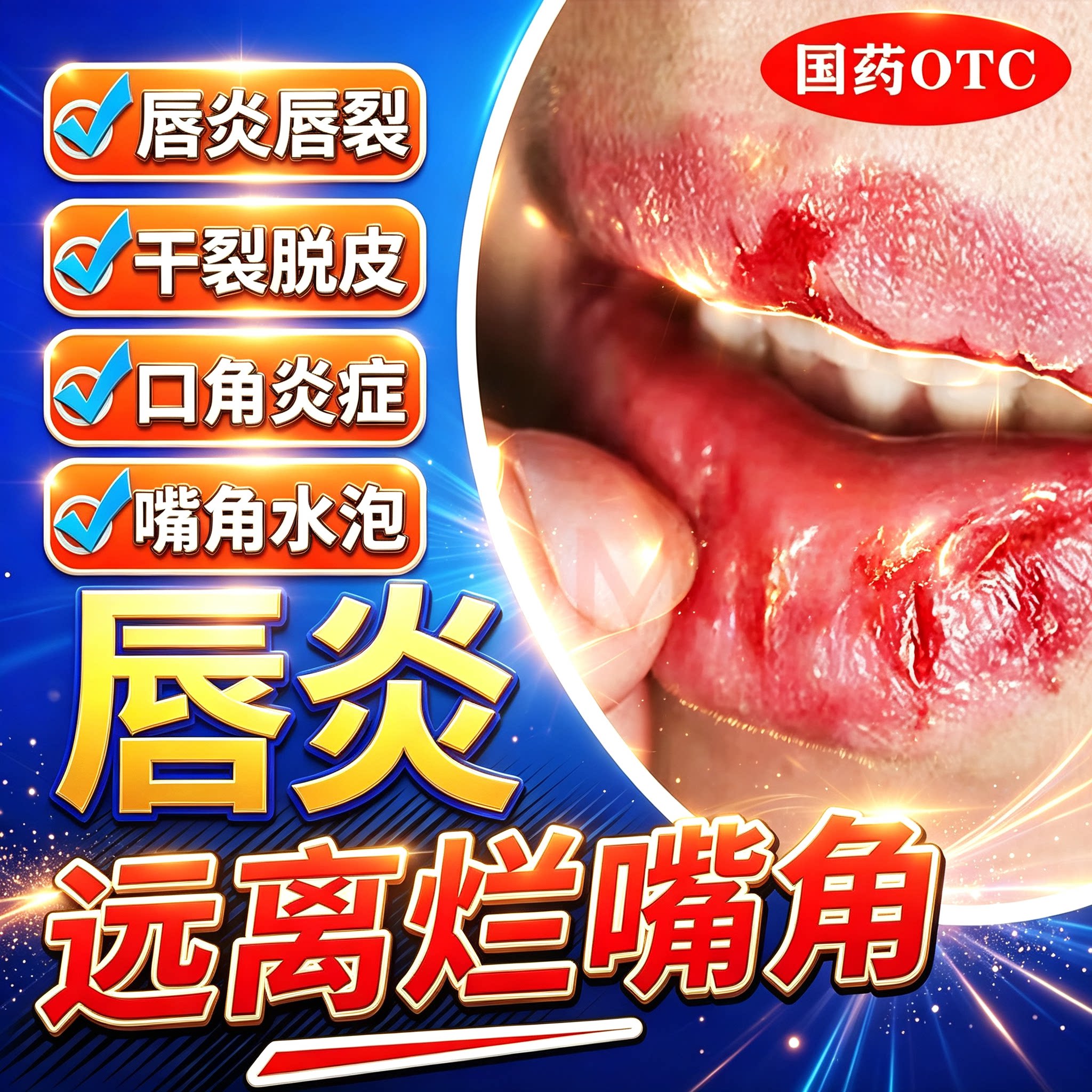 唇炎专用药膏唇炎唇膏嘴唇干裂脱皮修护儿童唇炎烂嘴角口角炎医用