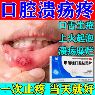 口腔溃疡专用药口舌生疮反复溃疡上火起泡牙龈肿痛牙龈炎牙周炎
