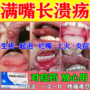 口腔溃疡专用药贴烂嘴巴烂舌头口舌生疮起泡灼痛反复口疮溃疡肿痛