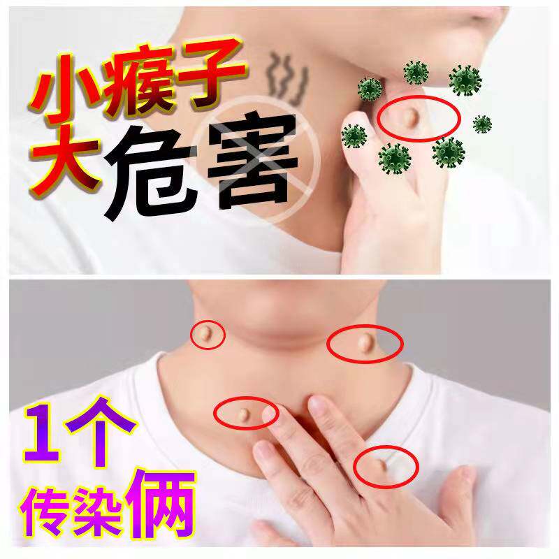 极速买二送一去跖疣净鸡眼瘊子刺猴去除足部脚底手部专用神器肉刺