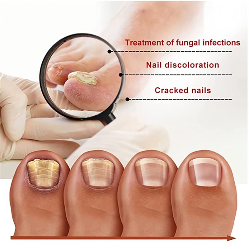 iBeaLee 7DAYS Repair Nail Fungus Treatments Essence Foot Car