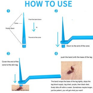 Green Alcohol Pads Beauty & Health Rubber Bands Skin Tag Rem