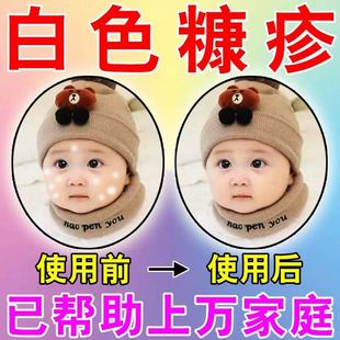 白色糠疹专用儿童脸上四肢起癣长白斑虫斑汗斑糠疹花斑晒斑桃花癣