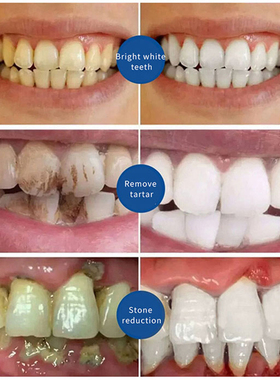 Removal Of Plaque Stains Decay Repair Of Cavities Caries Whi