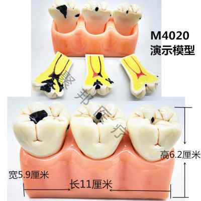 牙齿模型口腔教学模型带神经牙模正畸模牙科模型种植模型修复模型