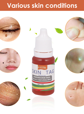 10ml Treatment Papillomas Removal of Warts Liquid kill Remov