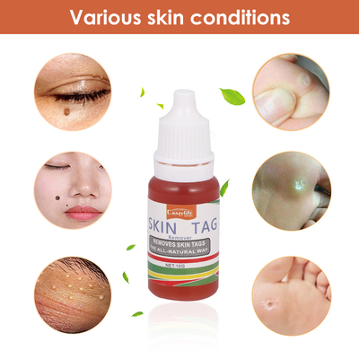 10ml Treatment Papillomas Removal of Warts Liquid kill Remov