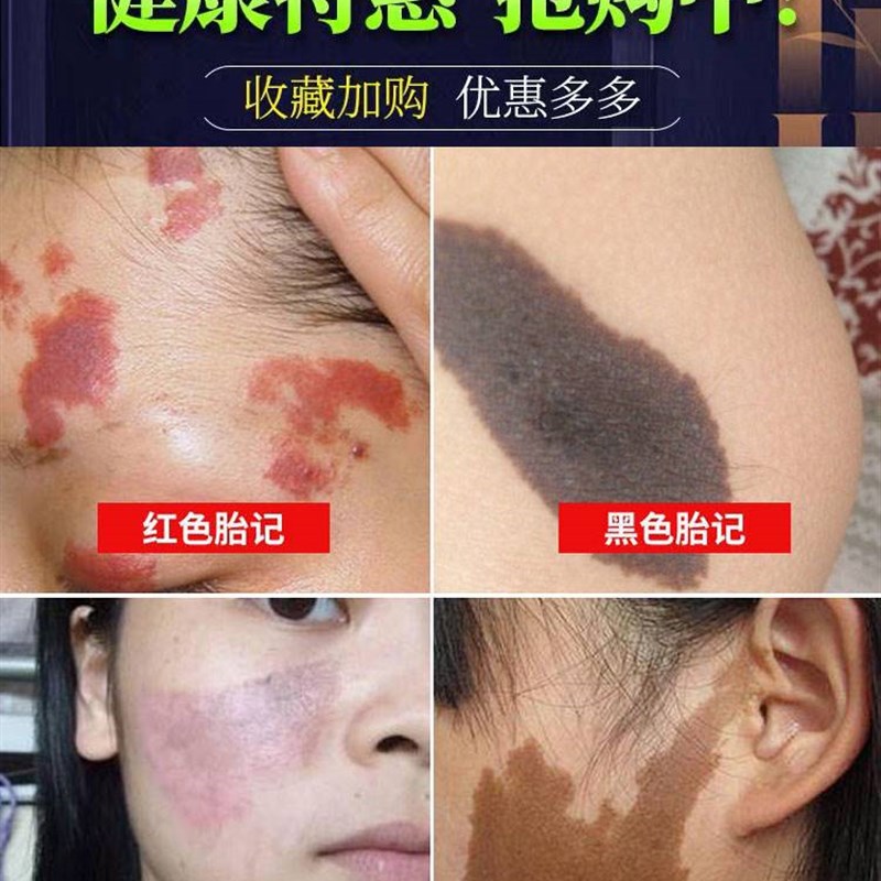 【当晚显效】去胎记除胎记脸部黑色素天生黑淡化红色咖啡斑神器药