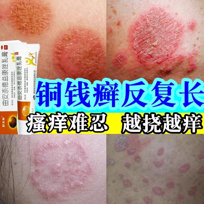 铜钱癣体癣牛皮癣专用药膏皮肤癣痒股癣大腿外用抑菌藓真菌感染