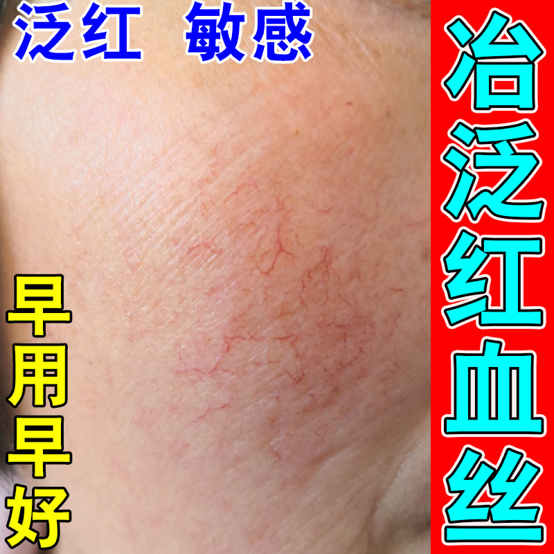 去脸上红血丝修复角质层薄改善敏感肌高原红换季脸上红痒