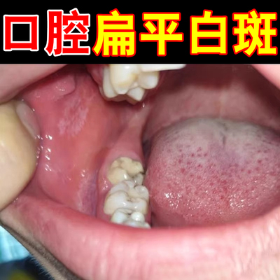 口腔内侧溃疡长白斑疼痛