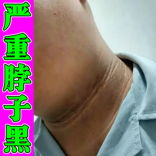 严重脖子黑洗不干净药去脖子周围粗糙发黑除黑棘皮黑色素沉淀膏