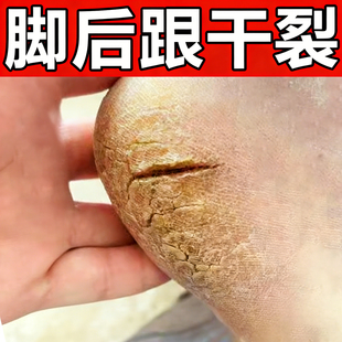 脚后跟干裂脚裂蜕皮脚上脚后跟手脚开裂修复药脚裂口子膏