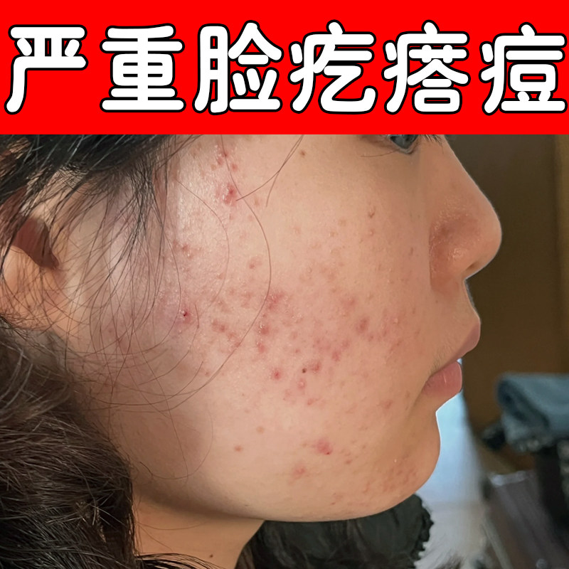 严重脸颊长红肿疙瘩痘外用修复药去脸上闭口粉刺痘额头下巴起痘痘