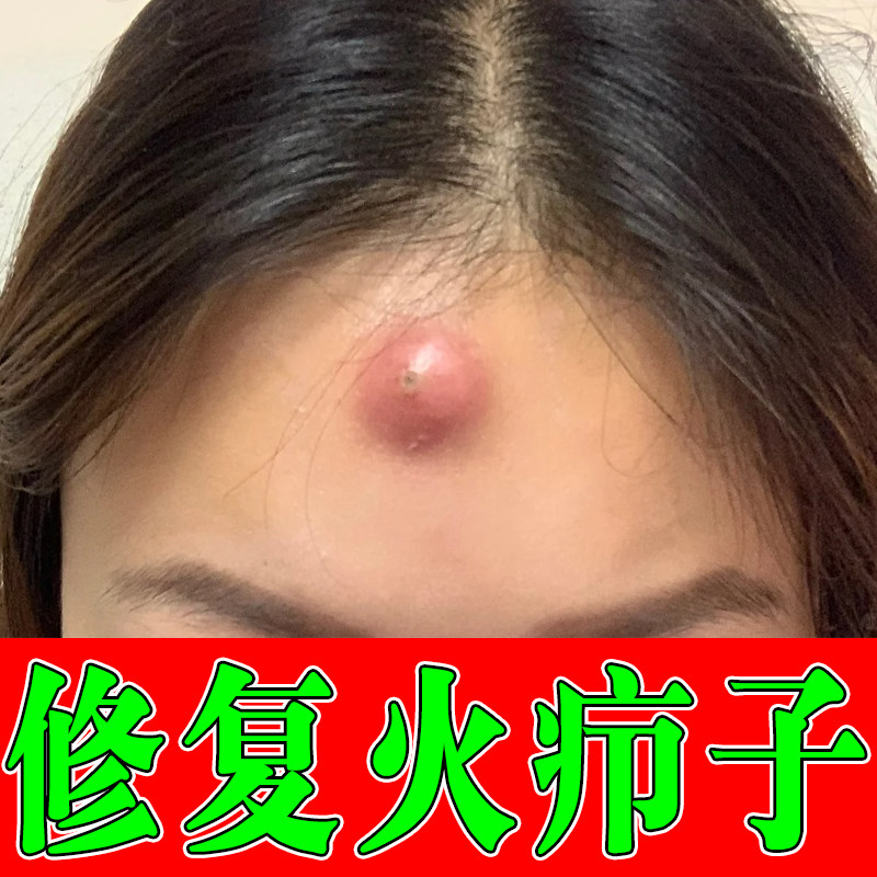 火疖子额头硬块疙瘩