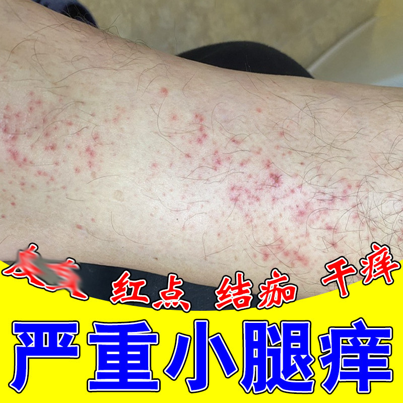 小腿痒长小红点皮肤过敏干痒粗糙身上痒起红疙瘩干燥一挠就痒修复
