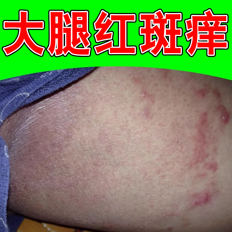 大腿内侧皮肤痒真菌痒感染腿上两侧过敏红斑干痒长小疙瘩痘痘乳膏