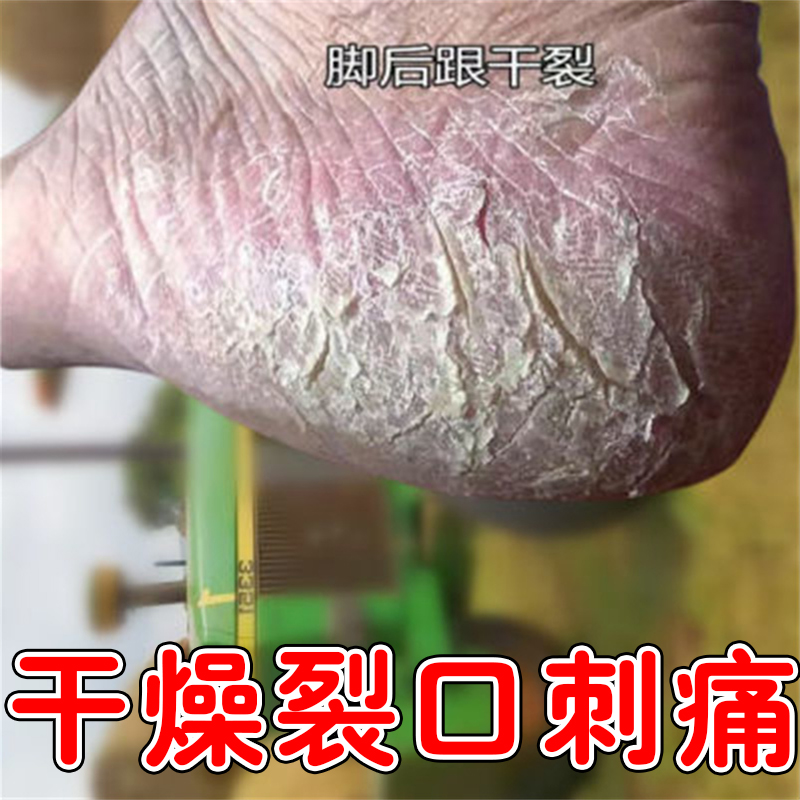 脚后跟干裂起硬皮足跟开裂干燥裂口子刺痛脚底掉皮起皮脚膜修复霜
