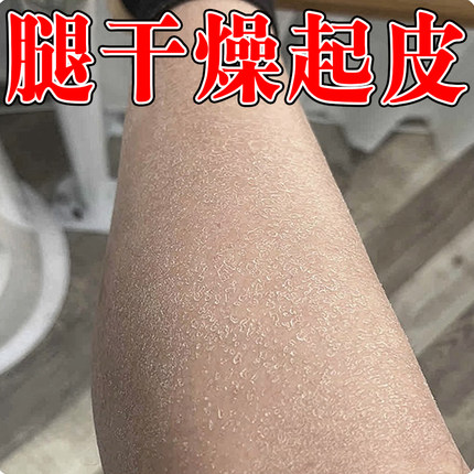 腿干燥起皮屑鱼鳞腿起皮干燥干皮掉皮小腿干燥起皮鱼鳞腿部鱼鳞片