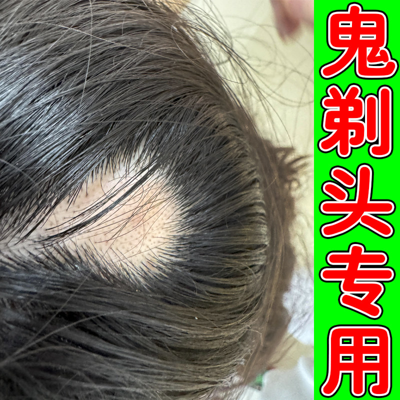小孩斑秃药儿童鬼剃头激活毛囊生皮肤消毒护理（消）