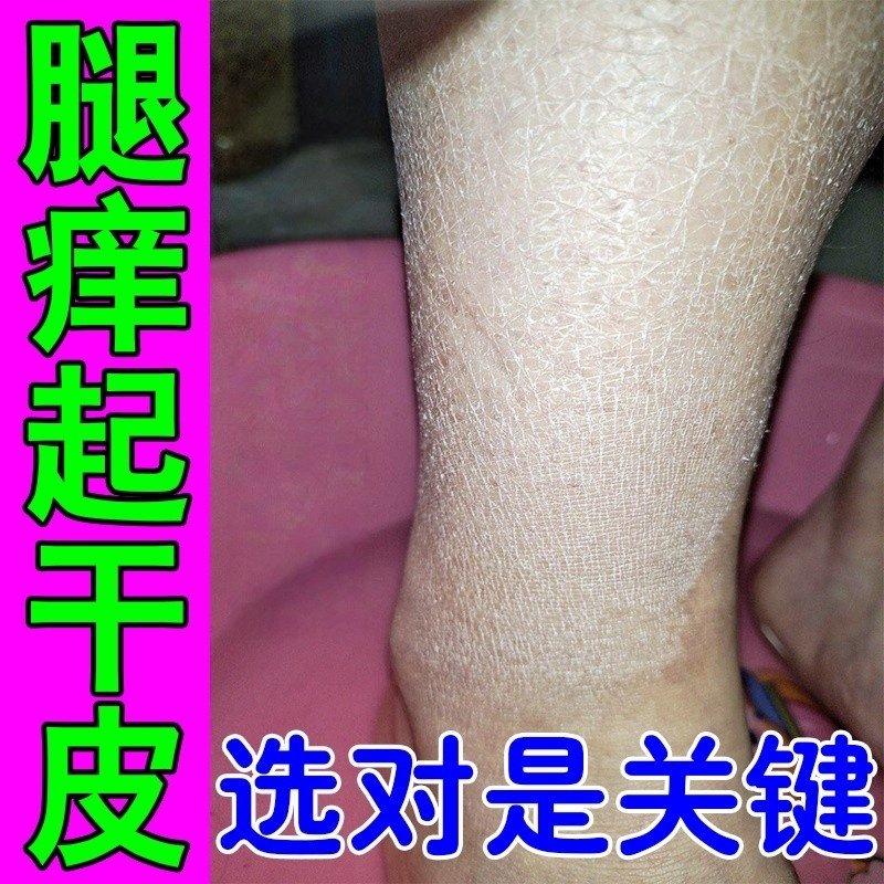 秋冬天腿上干燥起皮脱皮掉皮屑鱼鳞/病皮肤霜保湿补水身体乳,美容护肤/美体/精油,身体乳/霜,淘宝优惠券,粉丝福利购,淘宝优惠卷