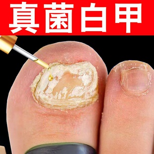 治真菌性白甲手脚指甲发白有白斑点空甲床分离分层修护专用液