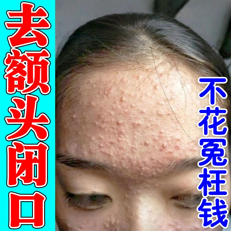 额头上长痘痘闭口密密麻麻小白点脂肪粒去学生青春痘去豆豆驱痘膏