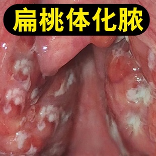 扁桃体发焱化脓肥大喉咙肿痛有白点异物痒滤泡增生草本喷剂