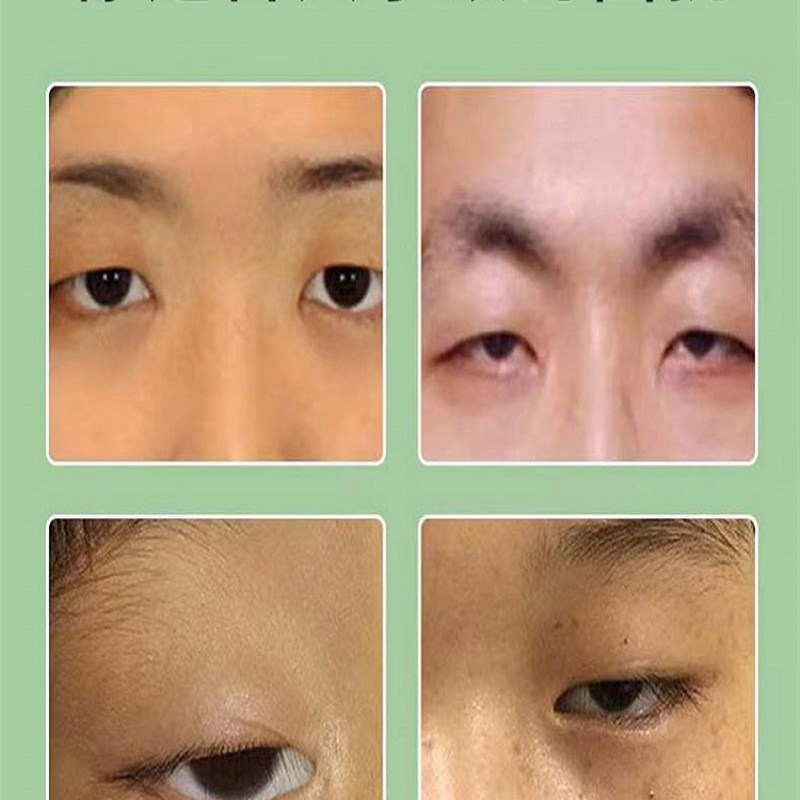 大小眼矫正器改善上眼皮下垂睑肌无力双眼皮贴神器提拉紧致防松弛