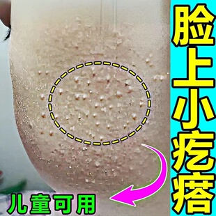 逆光疹修复儿童闭口粉刺去脸部下巴白头脸上有小颗粒专用膏