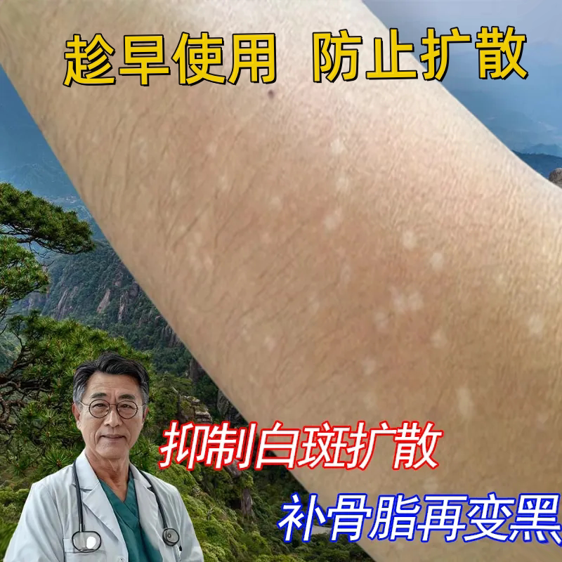 手臂长小白点白/斑花/斑汗/斑胳膊补骨脂促黑素白/斑用膏