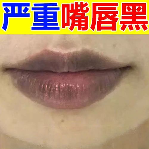 嘴唇黑色素改善唇周黑嘴角发黑发紫淡化唇色唇纹嘴巴暗沉唇膏