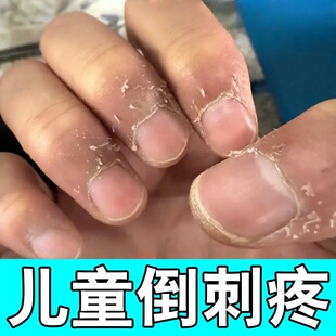去手指倒刺修复软膏手上长刺干燥脱皮起硬皮粗糙裂纹软化嫩肤膏