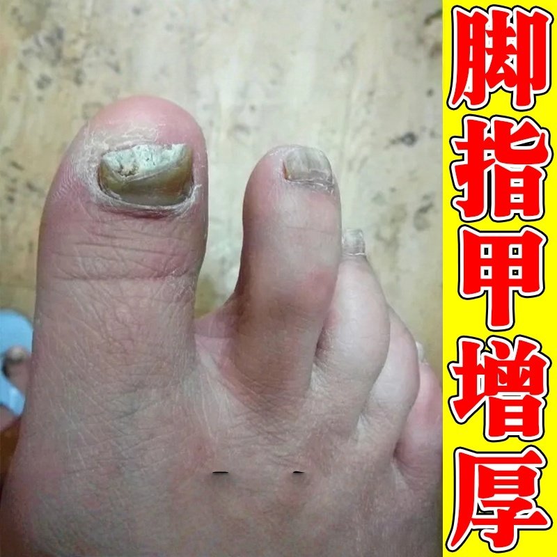 脚指甲发黄变厚变硬治真菌白甲空甲修复甲分离脱落软化液