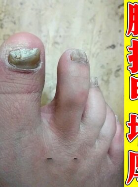 脚指甲发黄变厚变硬治真菌白甲空甲修复甲分离脱落软化液