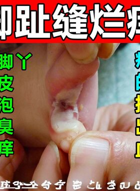脚缝痒脱皮烂脚脚趾缝烂痒脚丫子痒烂脚专用沙虫脚