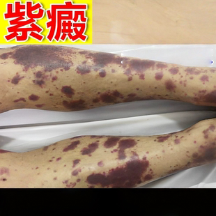 治过敏色素性紫皮下血色素沉着血/斑血点老人儿童四肢专用膏