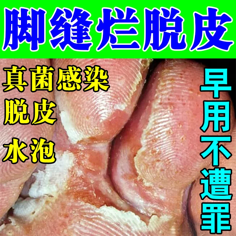 脚缝烂痒脱皮脚趾缝糜烂痒脚痒起泡烂脚脚指间发白溃烂疼痛膏