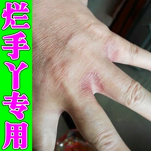 烂手丫专用膏软膏长期泡水手指缝溃烂痒红脱皮起泡手气开裂软膏
