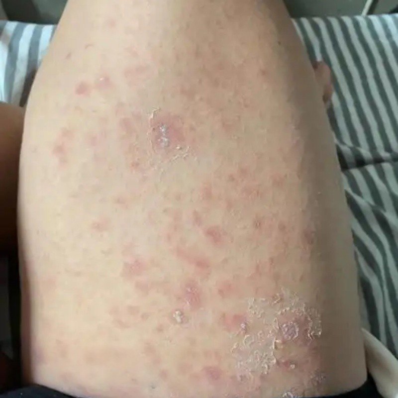 玫瑰糠/诊皮肤糠/诊软膏皮/诊湿/焱红色丘诊红斑诊/湿红斑鳞屑