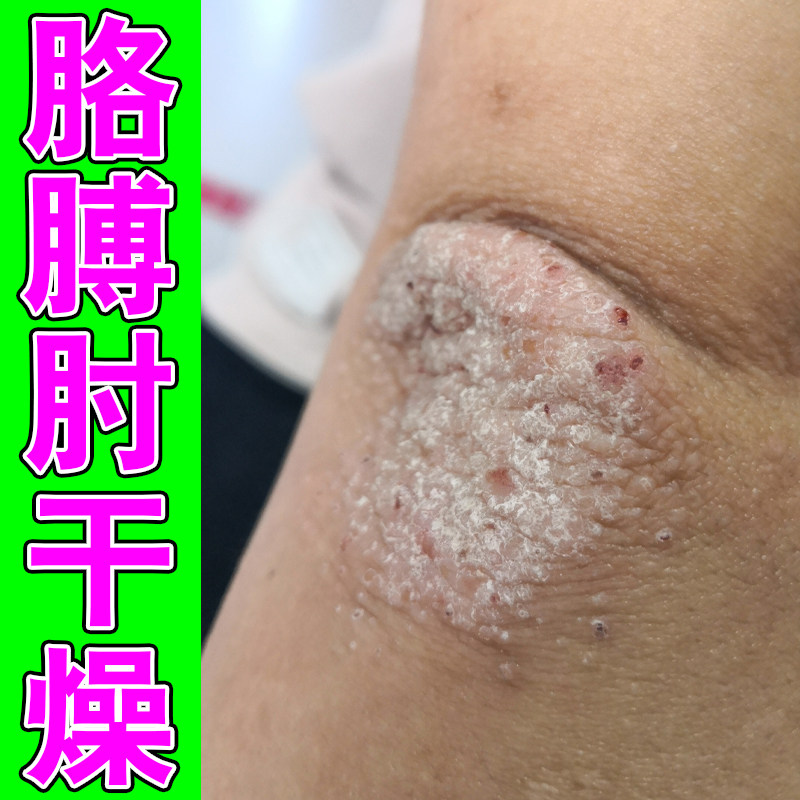 手肘干燥痒皮肤粗糙掉皮屑结痂痒干燥草木软膏