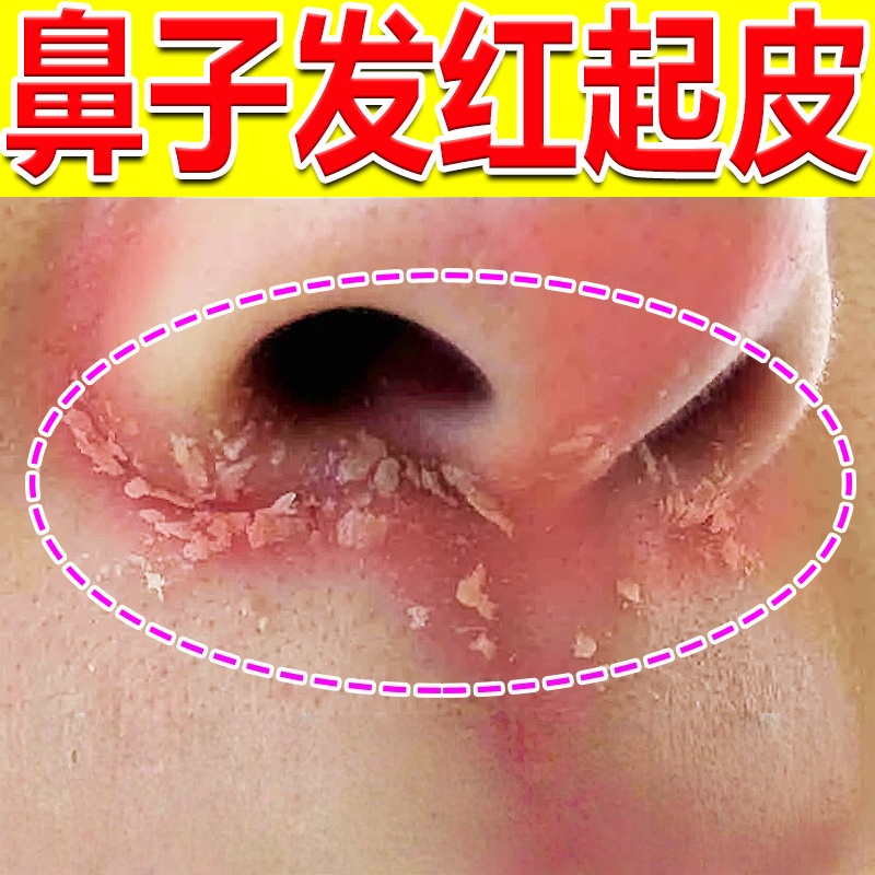 鼻子两侧发红脱皮鼻翼两边泛红干燥起皮掉皮酒糟鼻治红鼻头专用膏
