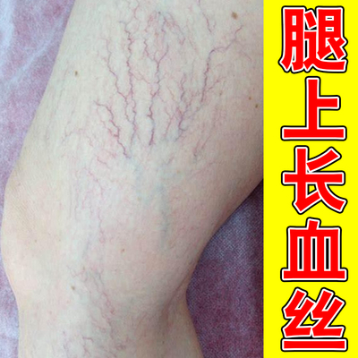 腿上有红血丝毛细血管扩张腿部青筋凸起缓解外用修复血丝腿软膏