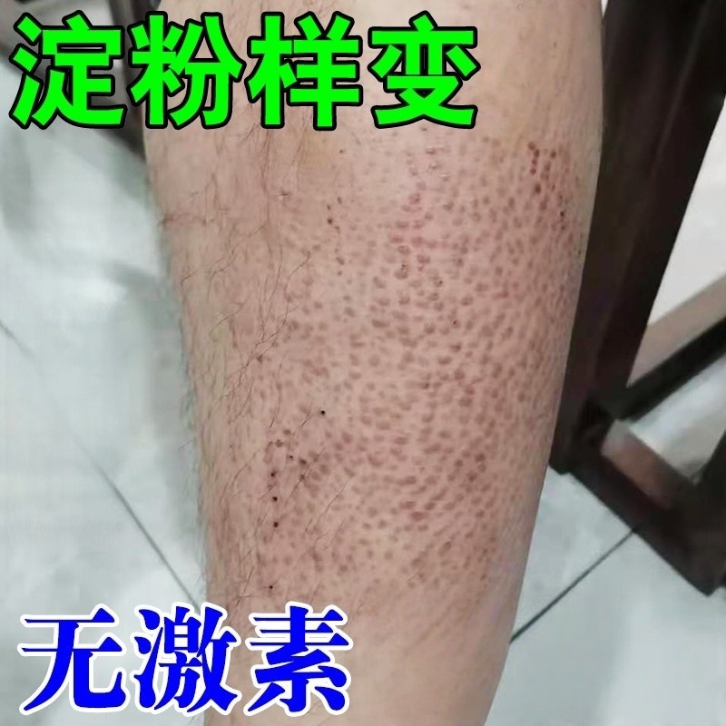 皮肤淀粉样变专用膏治顽固手臂小腿后背皮肤粗糙颗粒痒顽固皮藓